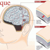 prevenir un ataque cerebral